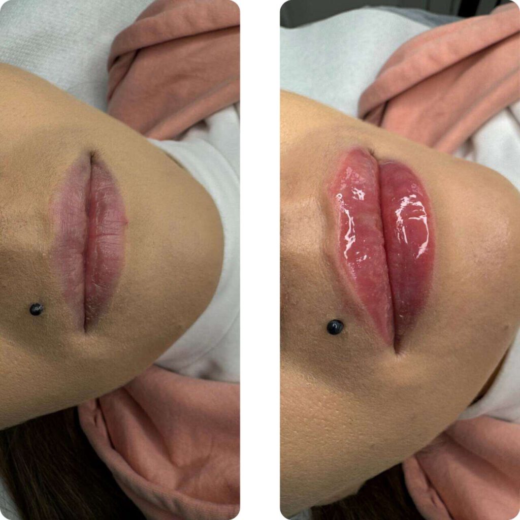 Przykład gotowych ust po wypełniaczu