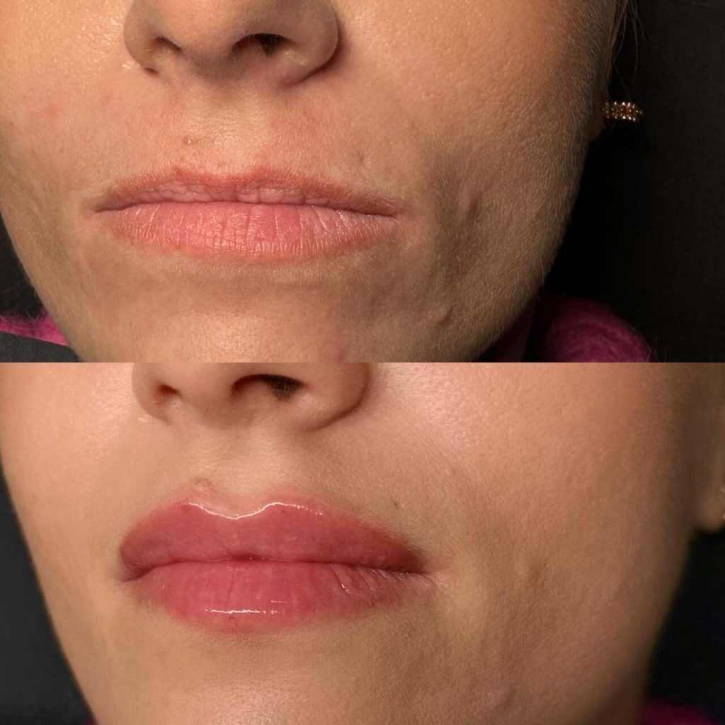 Zdjęcia ust przed i po zabiegu